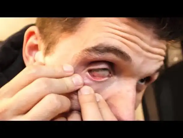 Was ist mit meinem AUGE los?